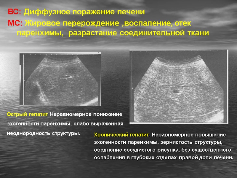 ВС: Диффузное поражение печени  МС: Жировое перерождение ,воспаление, отек паренхимы,  разрастание соединительной